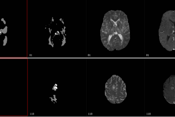 Texas scientist enlist supercomputers, machine learning to automatically identify brain tumors