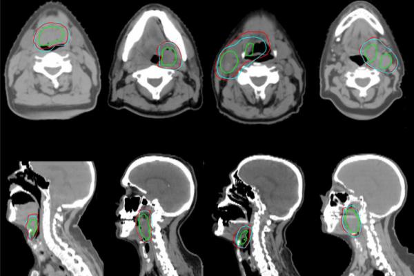 An AI Oncologist to Help Cancer Patients Worldwide